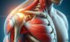 A Guide To Shoulder Impingement Syndrome