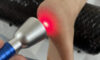 Laser Therapy: High-Intensity Treatment for Effective Relief