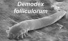 Demodex Mites: Link to Chronic Dry Eye Issues