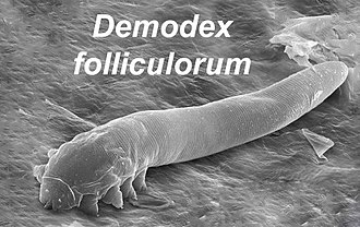 Demodex Mites: Link to Chronic Dry Eye Issues