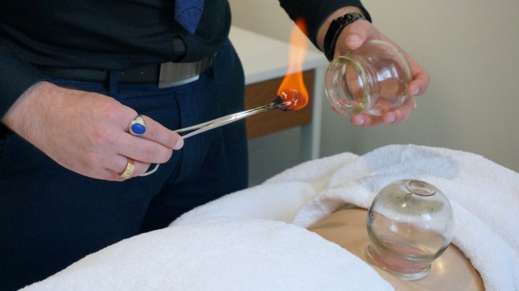Cupping Therapy: Explore Healing Benefits in Melbourne