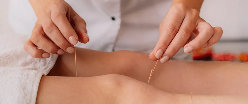 Acupuncture for Stress Relief: A Comprehensive Guide